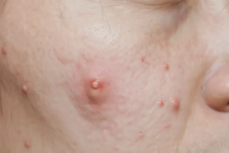 男性臉上偶爾長濕疹可不可以根治(圖4)