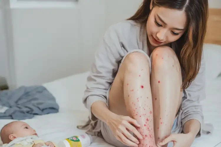 哺乳期媽媽小腿上出濕疹可不可以根治(圖4)