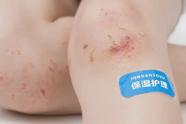 少兒小腿上有濕疹可以徹底自愈嗎(圖4)