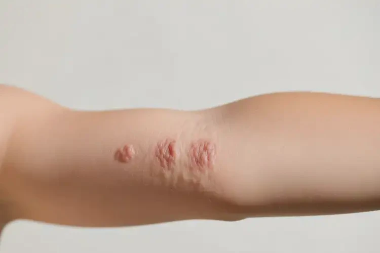 孩子手臂上出現(xiàn)濕疹可不可以根治(圖2)