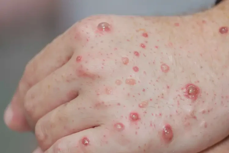 中学生手上出湿疹可不可以根治(图4)