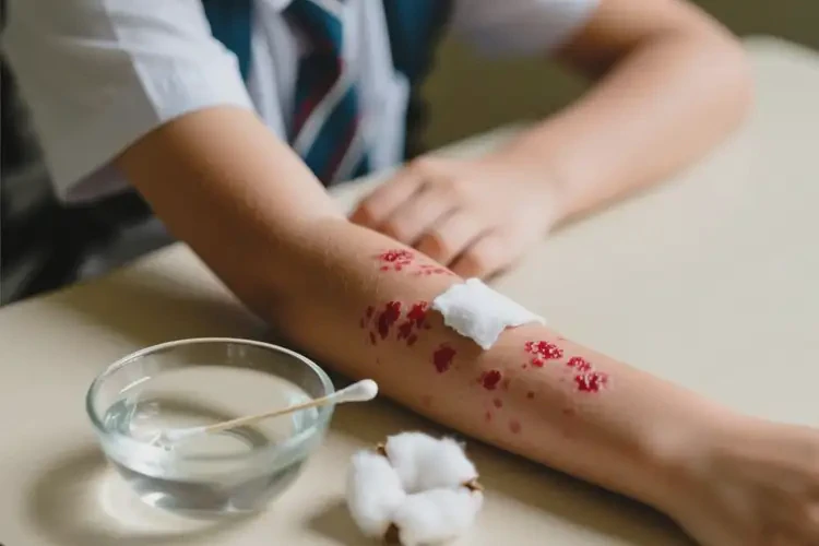 中學(xué)生手臂上起濕疹可不可以根治(圖2)