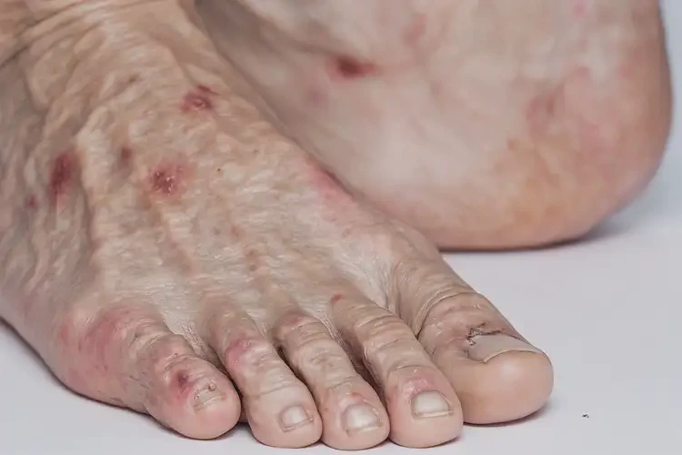 老年人腳上偶爾起濕疹可不可以根治(圖4)