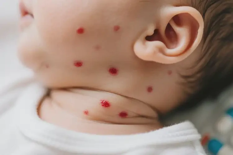 嬰兒脖子偶爾起濕疹不管它會自己痊愈嗎(圖2)