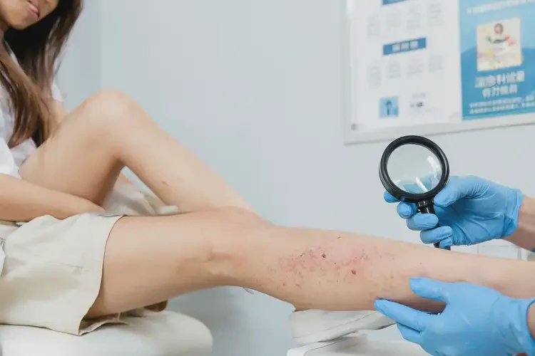 女生小腿出濕疹不管它會(huì)自己好嗎(圖4)