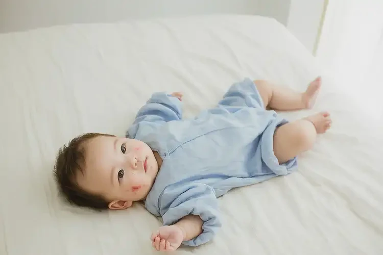 嬰兒四肢出現(xiàn)濕疹可以治好嗎(圖1)