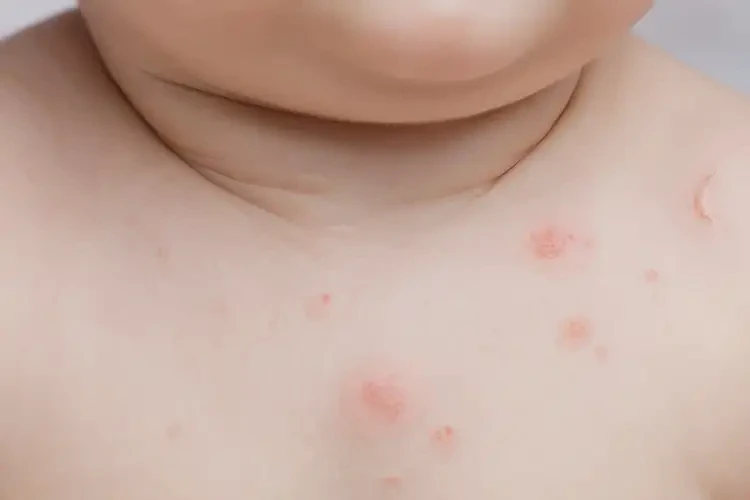 嬰幼兒脖子上經(jīng)常長濕疹可不可以根治(圖4)