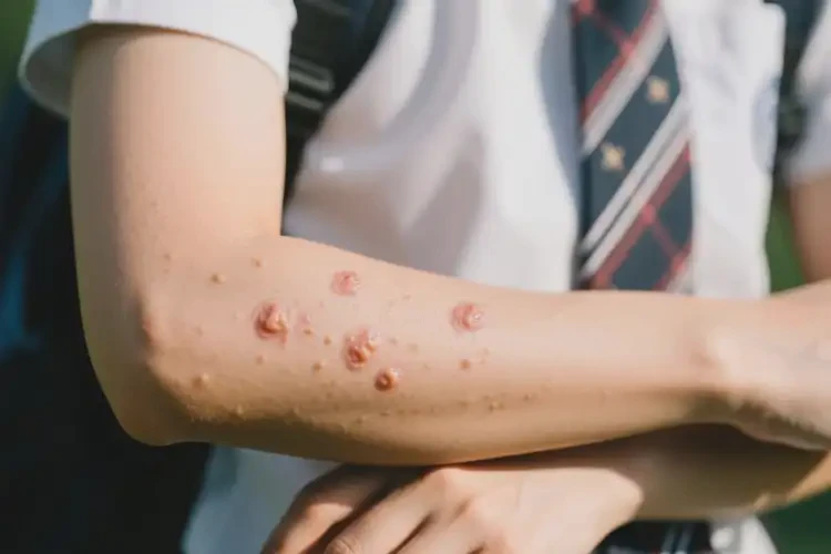 大學(xué)生手臂上偶爾長濕疹可不可以根治(圖3)