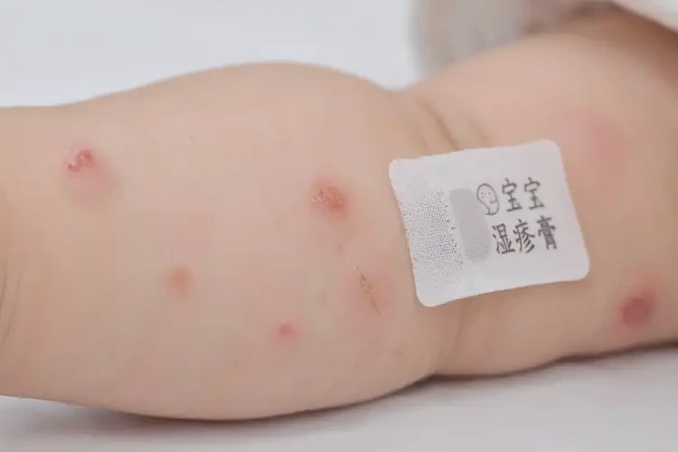 嬰幼兒手臂上偶爾長(zhǎng)濕疹可不可以根治(圖4)