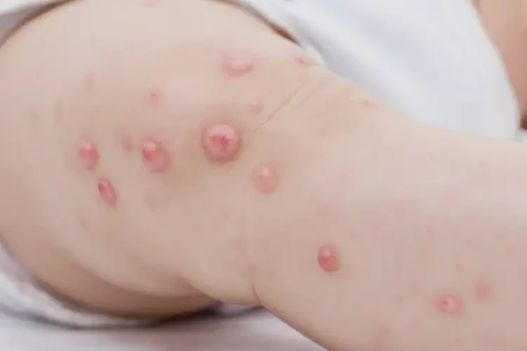 嬰幼兒大腿經(jīng)常長濕疹可以治好嗎(圖4)