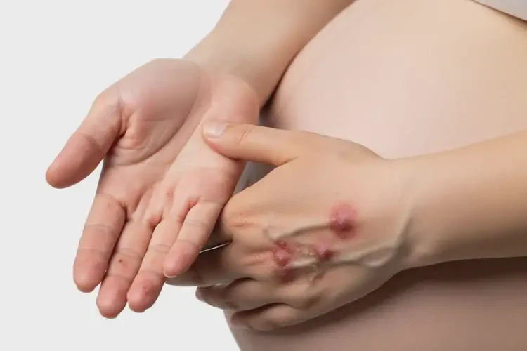 孕婦手上偶爾長濕疹可不可以根治(圖2)