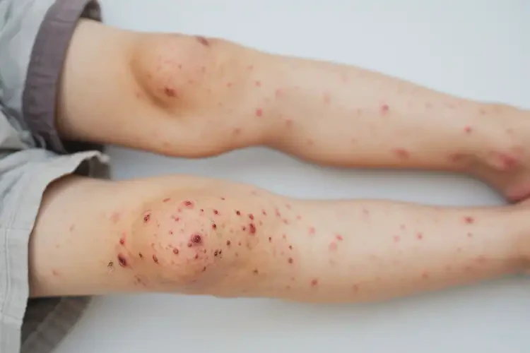 小兒四肢偶爾起濕疹可不可以根治(圖4)