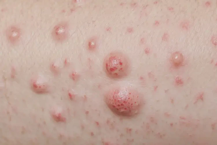 男性小腿出現(xiàn)濕疹可不可以根治(圖4)