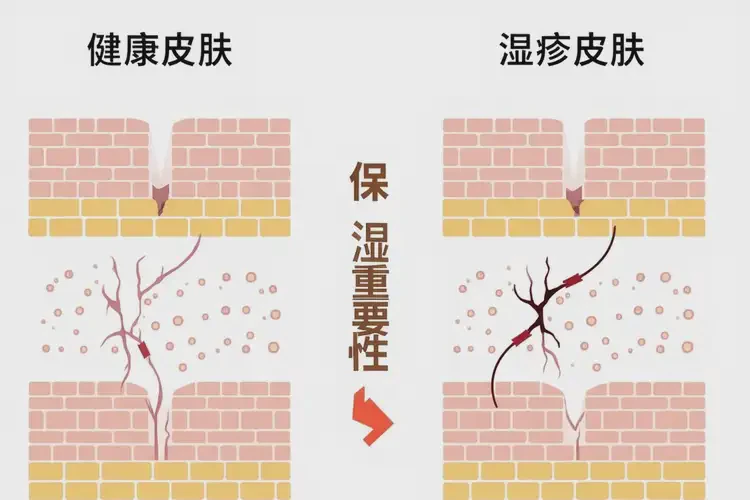 大學生屁股上偶爾起濕疹可不可以根治(圖2)