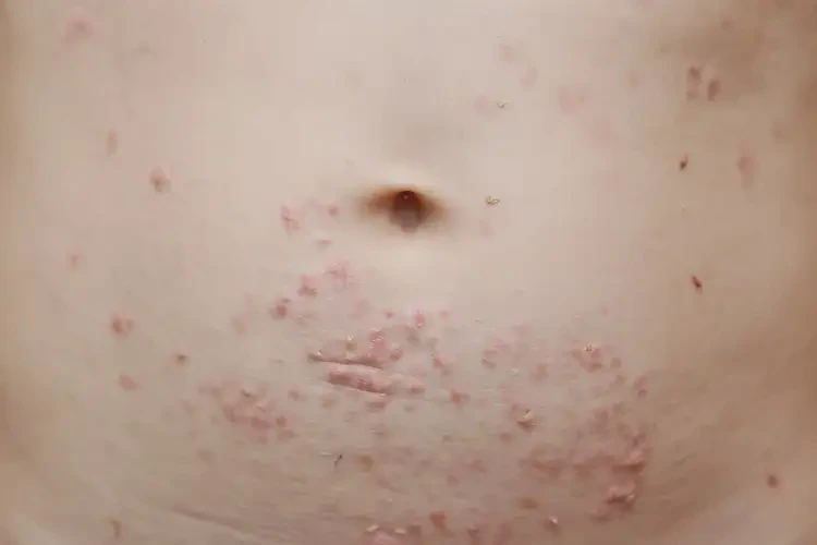 小孩肚子經(jīng)常長濕疹可不可以根治(圖4)