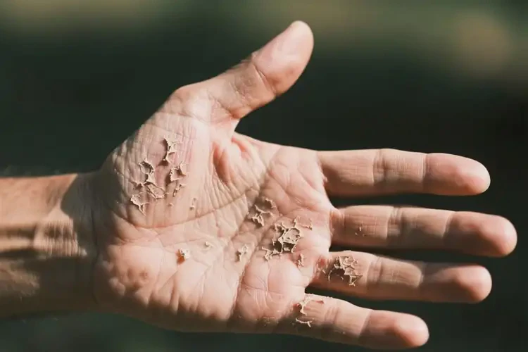 男人手上有濕疹能不能根治(圖3)