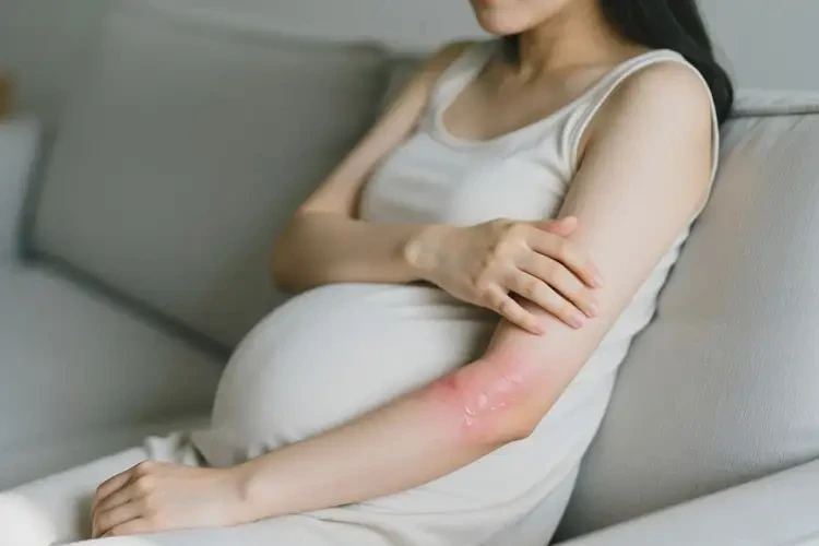 產(chǎn)婦手臂上出現(xiàn)濕疹可不可以根治(圖2)