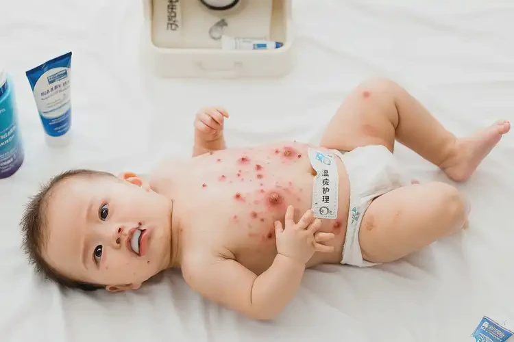 嬰兒肚子出現(xiàn)濕疹可以治好嗎(圖4)