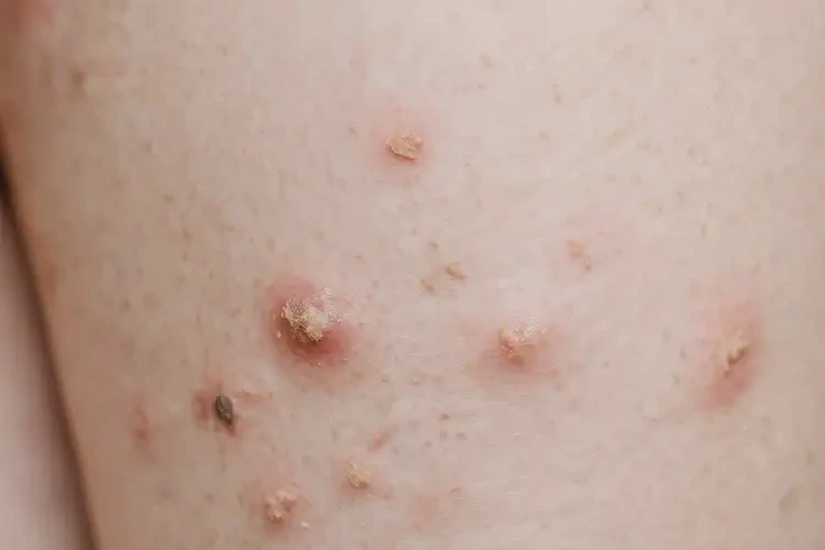 兒童大腿上長濕疹可不可以根治(圖4)