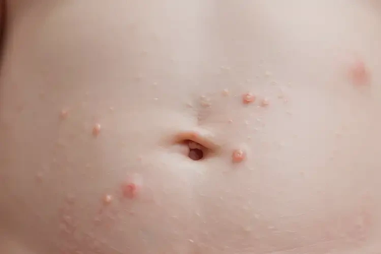 新生兒肚子上長濕疹不管它會(huì)自己痊愈嗎(圖4)