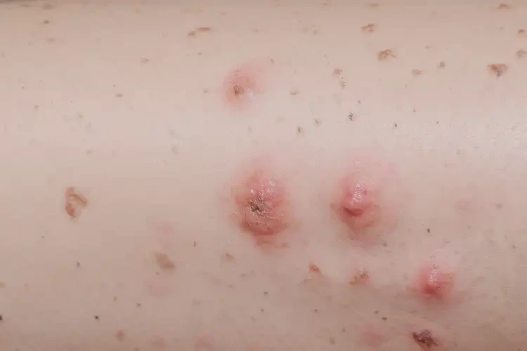 兒童大腿起濕疹可不可以根治(圖4)