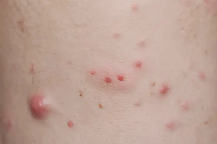 少兒肛周出現(xiàn)濕疹可不可以根治(圖4)