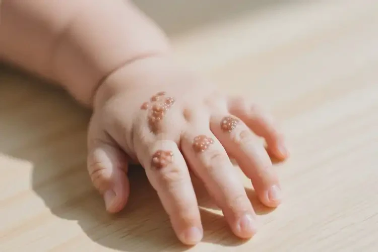 寶寶手上長濕疹可以治好嗎(圖2)