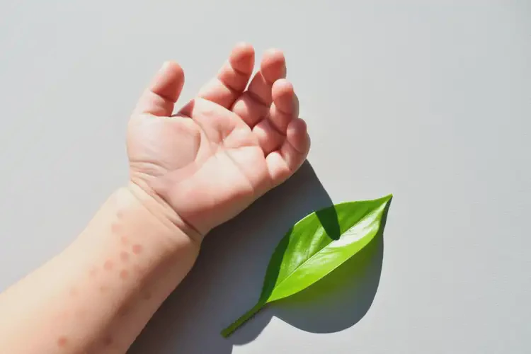 寶寶手臂上有濕疹可不可以根治(圖1)