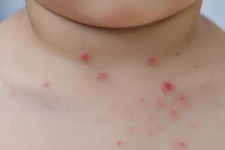 孩子脖子上长湿疹不管它会自己好吗(图4)