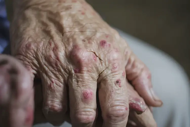 老人手上容易長濕疹可不可以根治(圖4)
