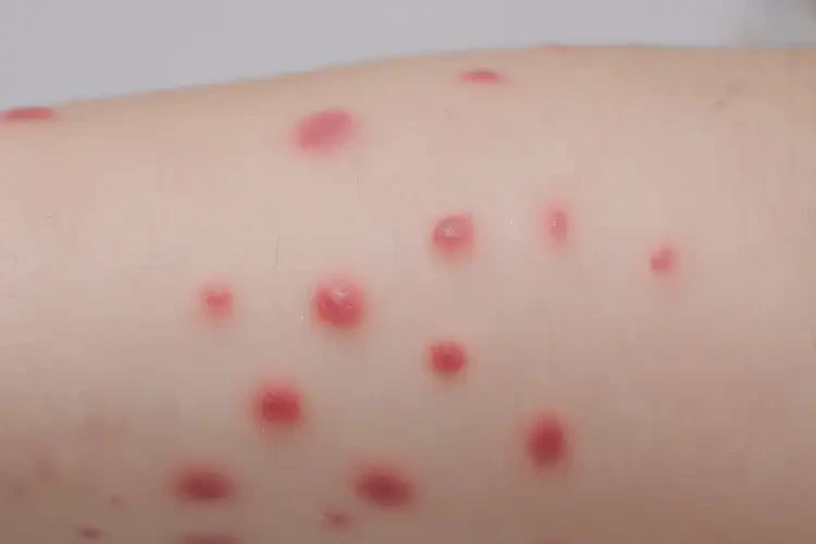 兒童屁股上有濕疹可不可以根治(圖4)