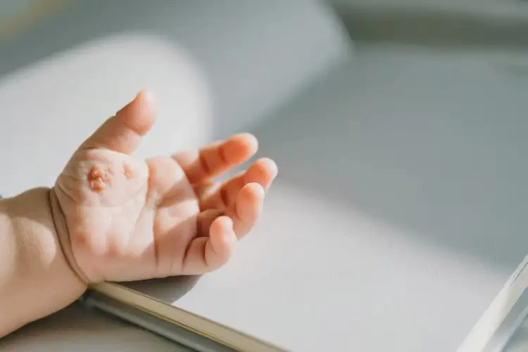 嬰兒手上偶爾起濕疹可不可以根治(圖1)