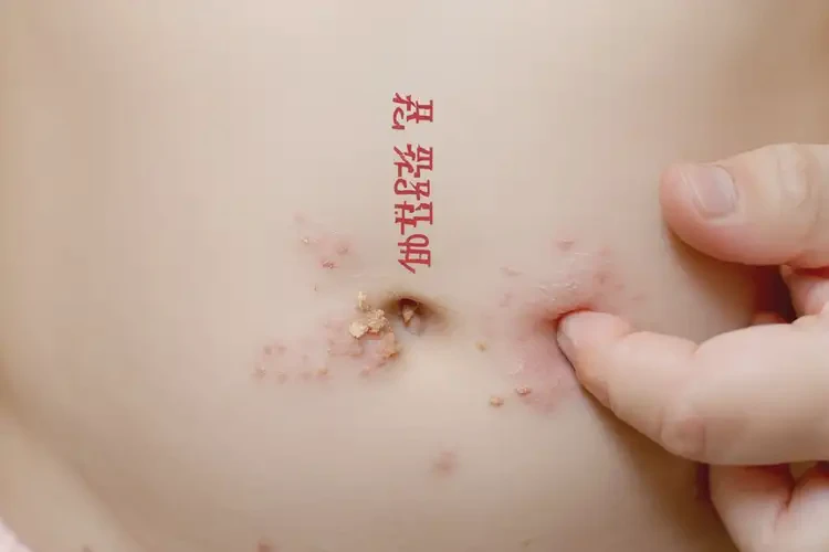 少兒肚子出濕疹可不可以徹底自愈(圖4)