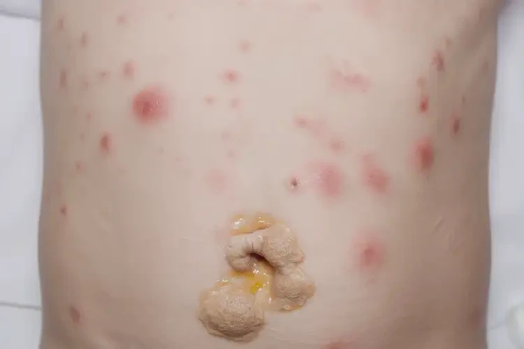 兒童肚子上偶爾起濕疹不管它會(huì)自己自愈嗎(圖3)