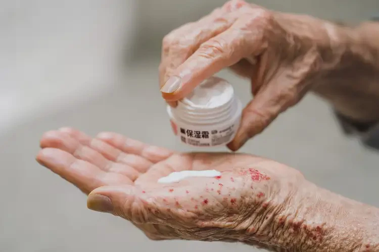 老人手上容易長濕疹可不可以根治(圖3)