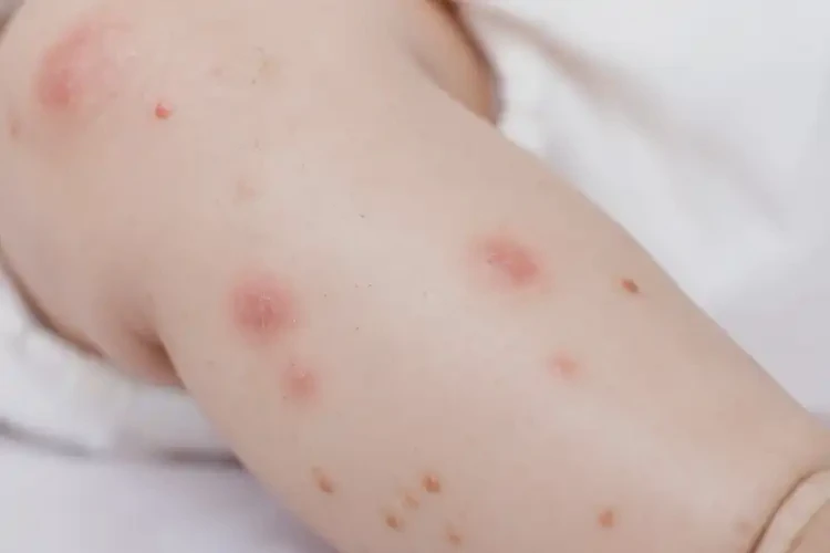 宝宝小腿容易长湿疹可以治好吗(图4)