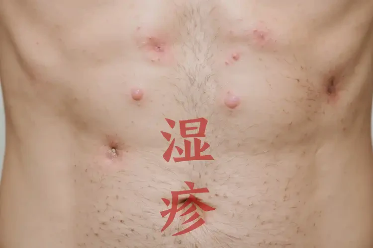 男性肚子經(jīng)常長(zhǎng)濕疹能夠徹底治愈嗎(圖4)