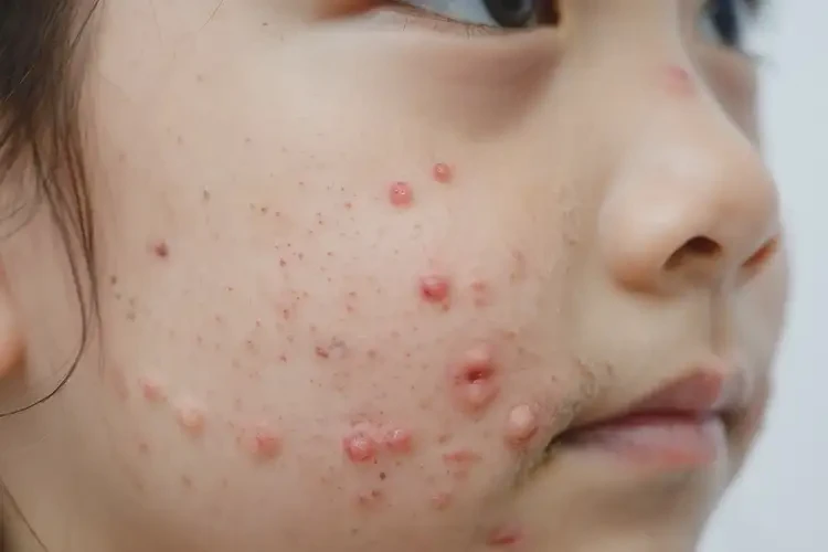 孩子面部經(jīng)常長濕疹可不可以根治(圖4)