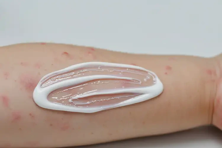 兒童手臂上容易起濕疹能靠自己自愈嗎(圖2)