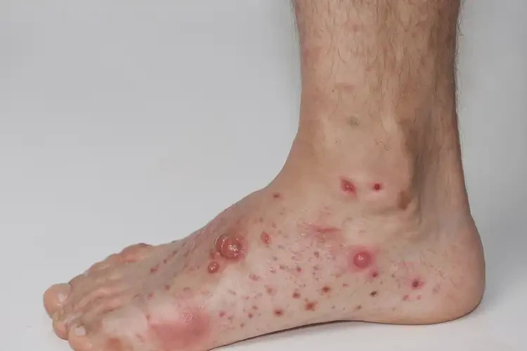 青年人脚上偶尔长湿疹可不可以根治(图4)