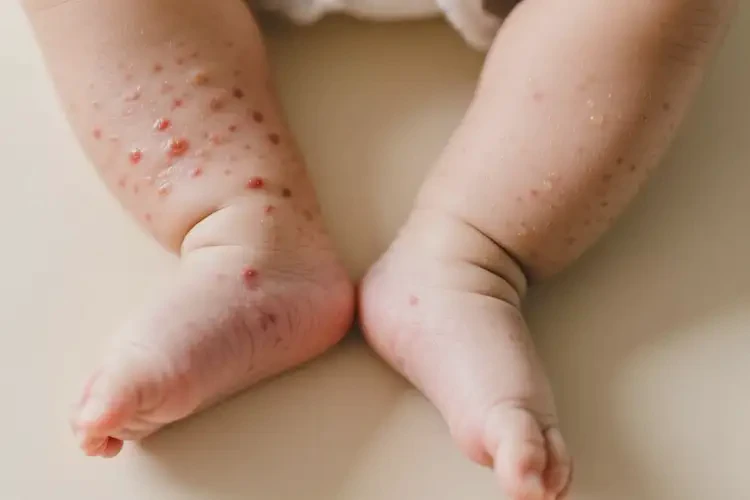 寶寶小腿出現(xiàn)濕疹不管它會(huì)自己痊愈嗎(圖3)