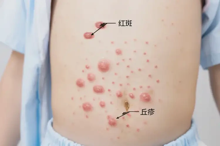 幼兒肚子有濕疹可不可以根治(圖4)