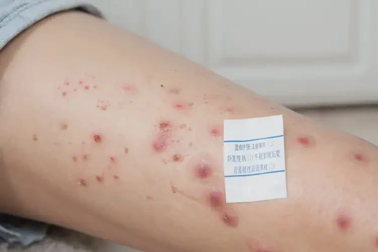 哺乳期媽媽小腿出現濕疹能不能根治(圖4)