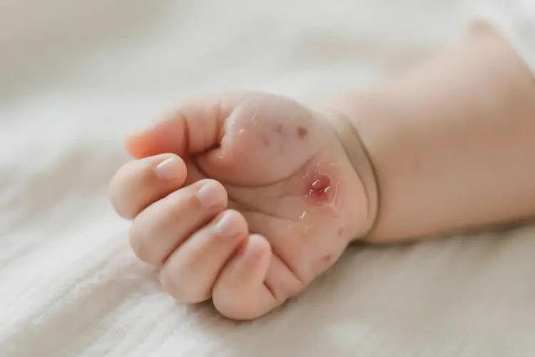 婴儿手上经常长湿疹可不可以根治(图2)