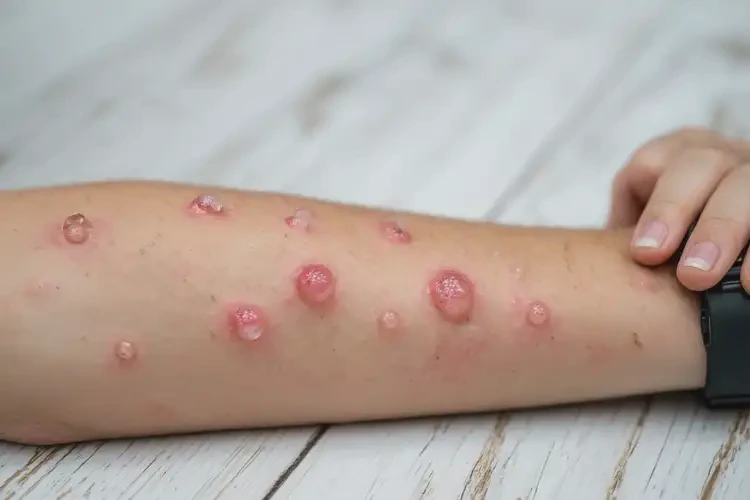 大學(xué)生手臂有濕疹不管它會(huì)自己好嗎(圖2)