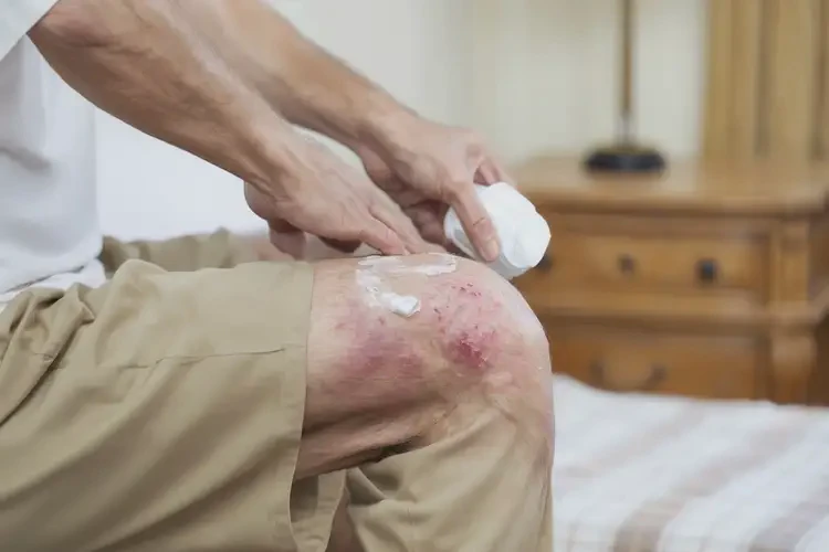 男生屁股上起濕疹可不可以根治(圖1)