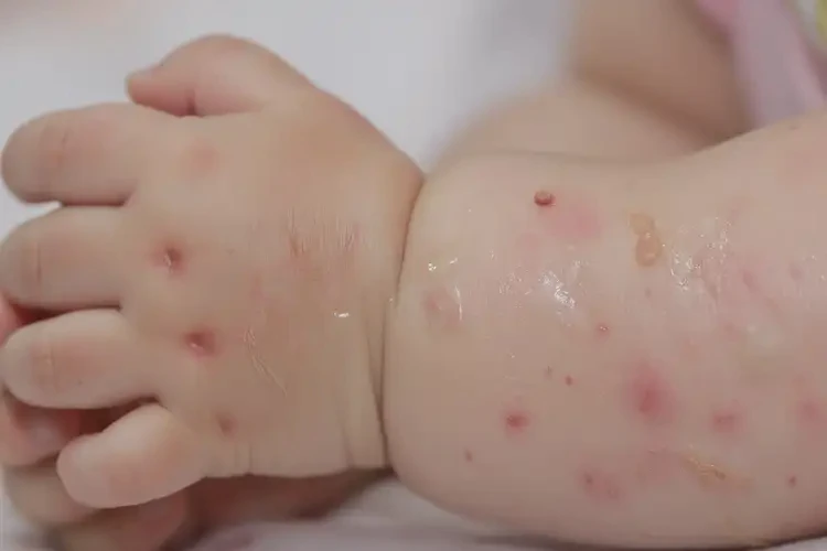 幼儿手臂有湿疹可不可以彻底自愈(图4)