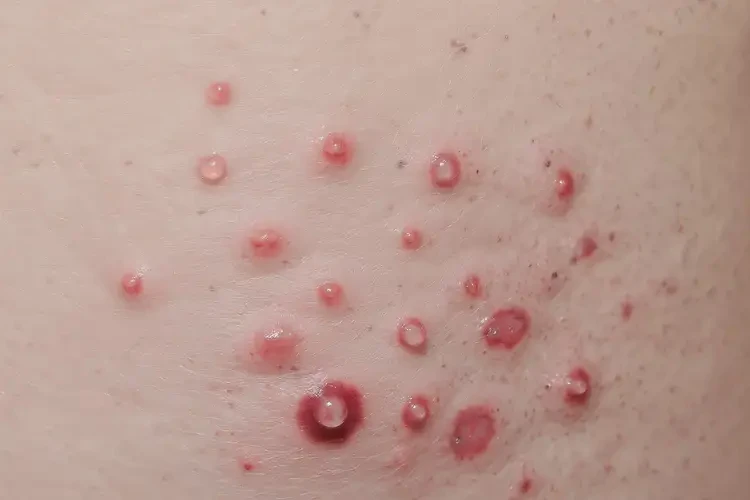 男人肛周偶爾長濕疹能不能徹底自愈(圖4)