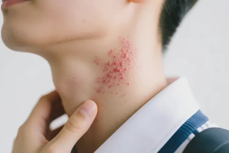 大學生脖子上容易長濕疹可不可以根治(圖4)