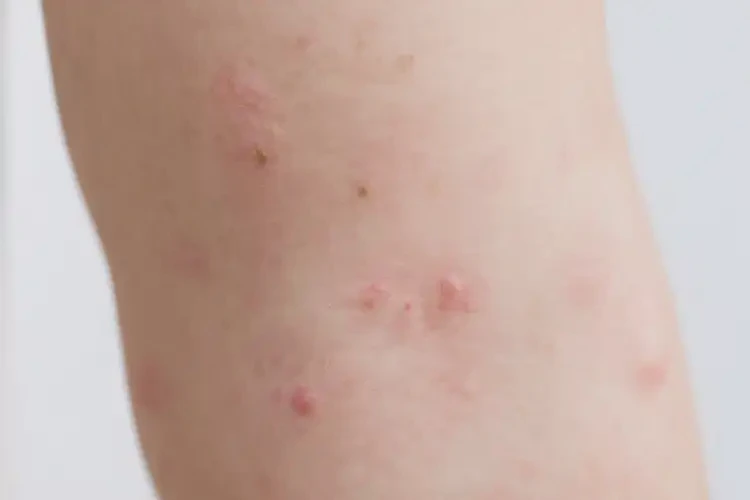 孩子身上偶爾長濕疹可不可以根治(圖4)